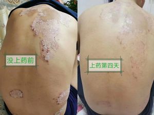 古村奇草抑菌膏可以调理神经性皮炎，湿疹吗？几盒见效？